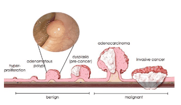 Tổn thương polyp khi còn khu trú ở lớp niêm mạc (nhóm tổn thương lành tính (benign) phía bên trái), và khi đã ung thư hoá xâm lấn xuống lớp cơ, lớp thanh mạc (nhóm tổn thương ác tính (malignant) bên tay phải)