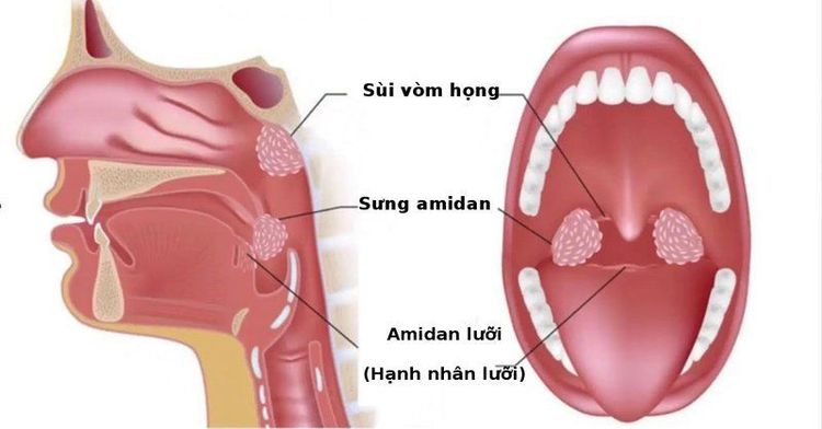 Phẫu thuật thắt động mạch cảnh ngoài được chỉ định khi người bệnh bị chảy máu sau cắt amidan
