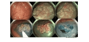 Polyp đại tràng được cắt bằng kỹ thuật EMR