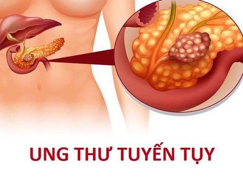 Nguy cơ ung thư tuyến tụy có liên quan đến việc bạn đã sử dụng thuốc tránh thai đường uống