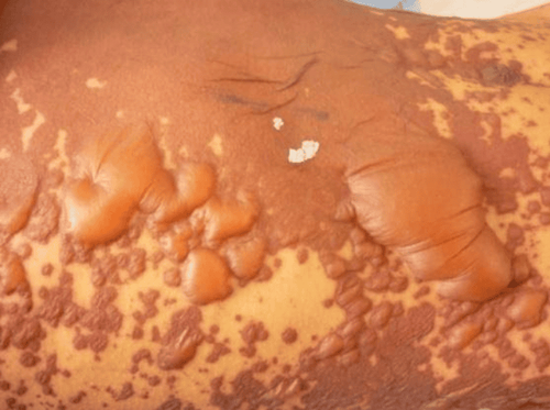 Bọng nước trong tổn thương da nặng