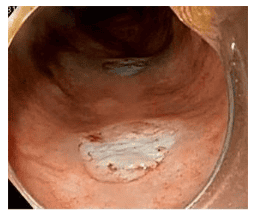 Thành đại tràng sau khi cắt polyp bằng kỹ thuật sinh thiết lạnh