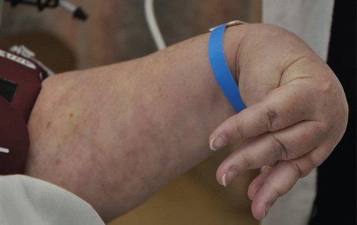 Nguyên nhân gây ra biến chứng đột quỵ co cứng là do các tế bào thần kinh vận động bị tổn thương