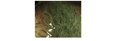 Sự biến mất của các cấu trúc vi bề mặt và vi mạch máu ở bề mặt polyp, nghĩ đến một trường hợp polyp ung thư hoá, đã xâm lấn đến lớp dưới niêm