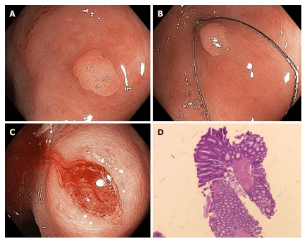 Cắt polyp bằng thòng lọng không sử dụng dòng điện (sinh thiết lạnh)