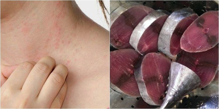 Sốc phản vệ là tình trạng sốc khi cơ thể tiếp xúc với dị nguyên, có thể là thức ăn, thuốc