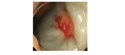 Một trường hợp polyp không nâng lên được sau khi tiêm vào lớp dưới niêm (Non-lifting sign), không cắt được qua nội soi.