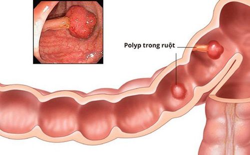 Polyp trong lòng đại tràng
