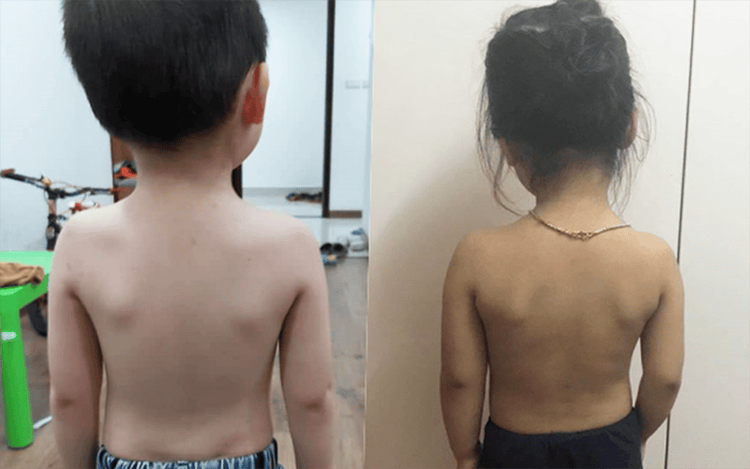 Tỷ lệ trẻ thành niên bị cong vẹo cột sống đang có xu hướng gia tăng