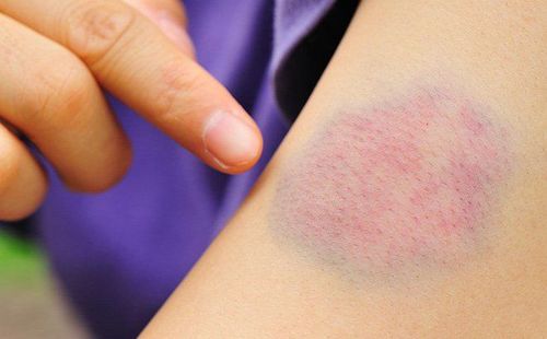 Các dấu hiệu hiệu xuất huyết da