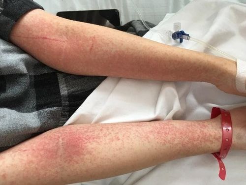 Ngoại ban do thuốc