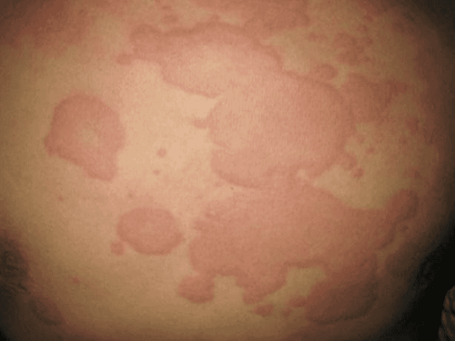 Biểu hiện mày đay cấp trên người bệnh có phản ứng dị ứng thuốc