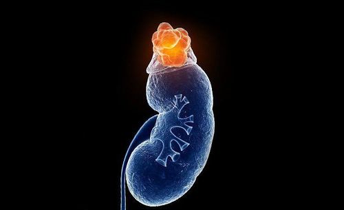 Suy tuyến thượng thận là tác dụng phụ toàn thân hiếm gặp của corticosteroid