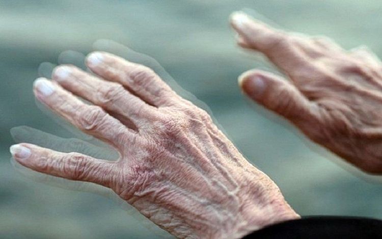 Bệnh Parkinson bắt đầu bằng dấu hiệu rung nhẹ ở một bên tay rồi phát triển dần