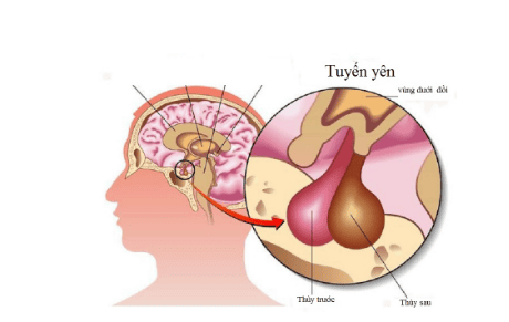 U tuyến yên tăng tiết prolactin