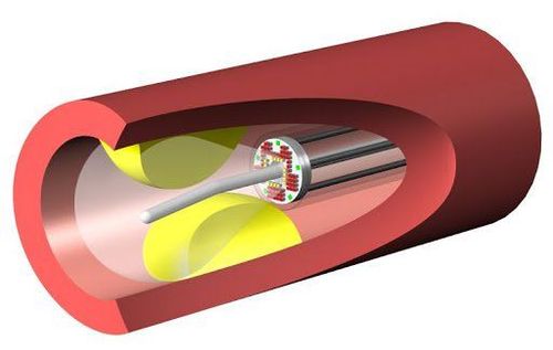 Một đầu của ống gắn vào đầu dò siêu âm trong lòng mạch