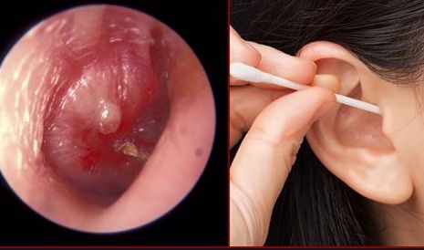 Không nên dùng tăm bông hay vật nhọn khi lấy ráy tai