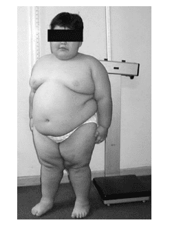 Trẻ mắc hội chứng Parder Willi do UPD xảy ra ở nhiễm sắc thể 15