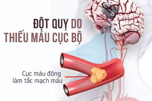 Đột quỵ do thiếu máu cục bộ thường gặp ở người lớn tuổi