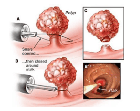 Kỹ thuật cắt polyp đại tràng qua nội soi