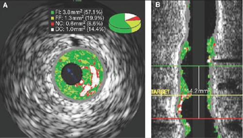 Siêu âm trong lòng mạch có vai trò quan trọng trong chẩn đoán và điều trị bệnh lý mạch máu