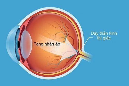 Bệnh nhân tăng nhãn áp được sự chỉ định của bác sĩ khi sử dụng thuốc