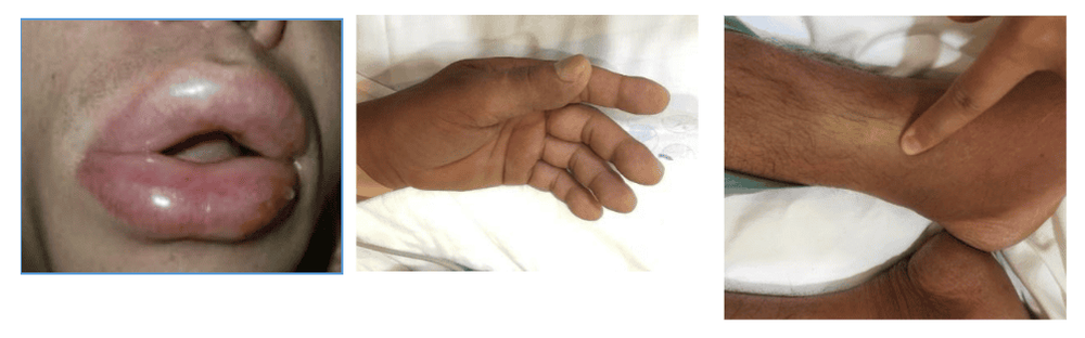 Phù môi và ban giãn mạch ở bệnh nhân sốc phản vệ